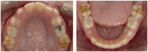 Molar incisor hypomineralisation (MIH)