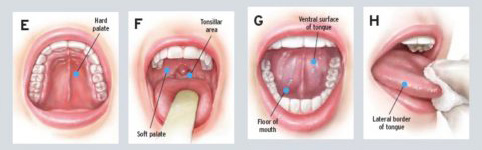 tumore del cavo orale sintomi