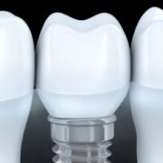 durability of the dental implant
