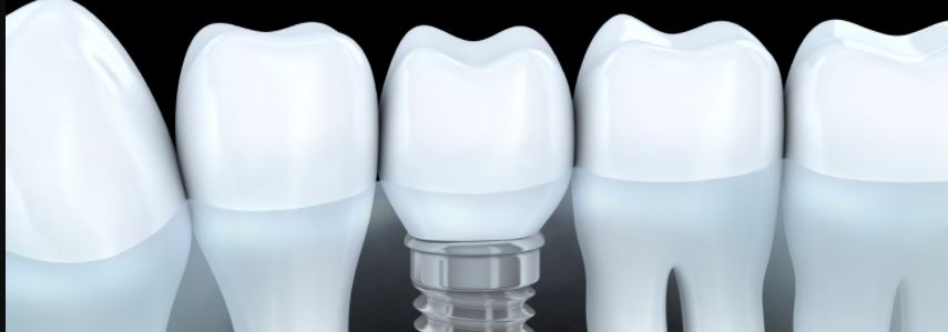 durability of the dental implant