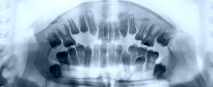 bone atrophy zygomatic implantology