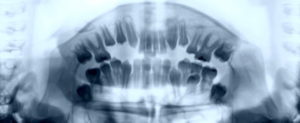 bone atrophy zygomatic implantology milan