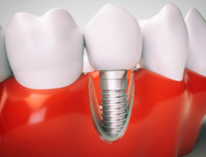 perimplantitis dental implants 