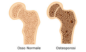 osteoporosi menopausa implantologia