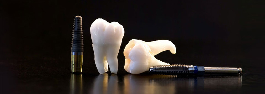 Dental implants