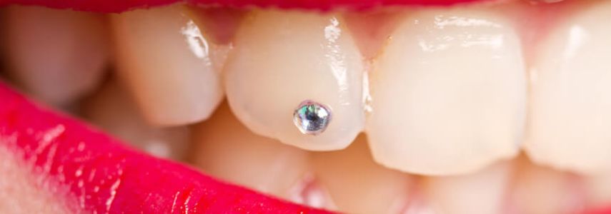 Brilliant on the tooth: why it is important to contact a dentist