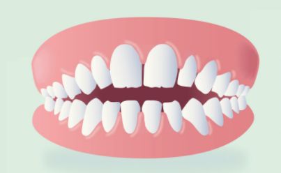Ciuccio: quando toglierlo per evitare danni ai denti e al palato
