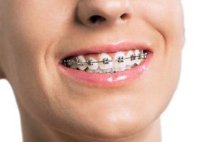 orthodontic treatment dentist milan