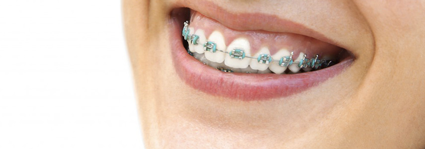 orthodontic treatment dentist milan