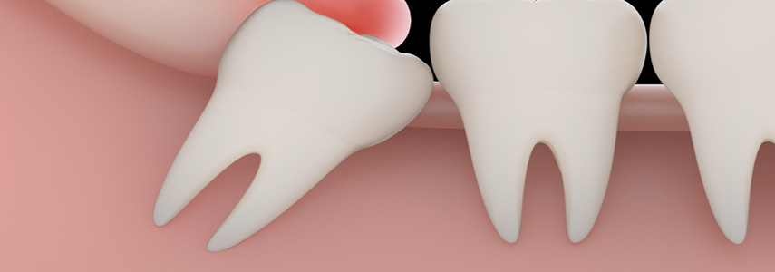 wisdom tooth