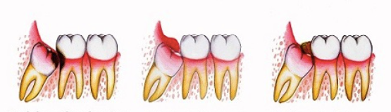 wisdom tooth extraction