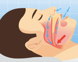 snoring bite