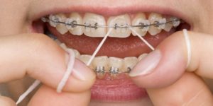 braces for teeth damage