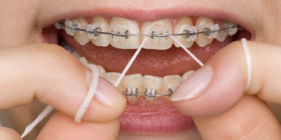 L'apparecchio fisso ortodontico: a cosa serve?