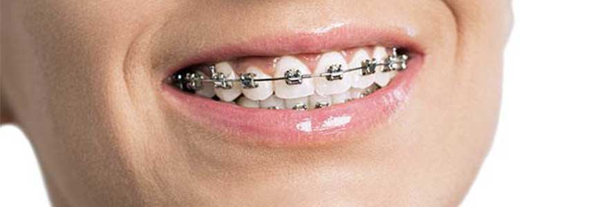 braces for teeth damage