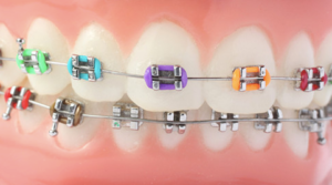 braces for teeth damage