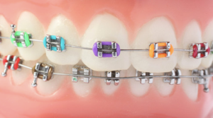 milano orthodontic appliance