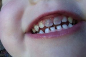 denti neri bambini dentista milano