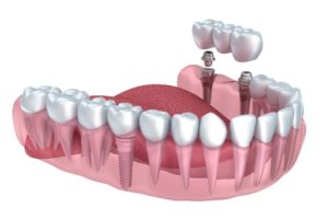 denture or implantology