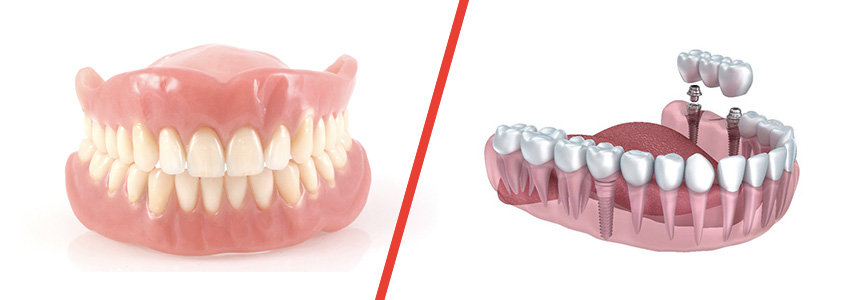 Dentiera o intervento di implantologia? Cosa conviene scegliere?