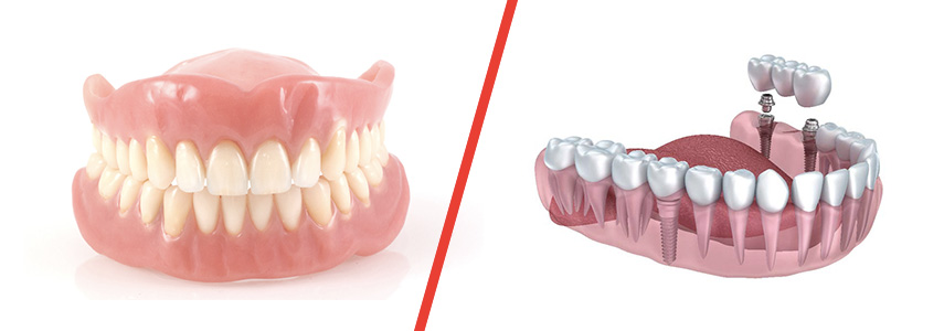 Milan denture or implantology