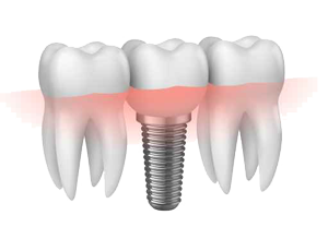 deferred loading implantology