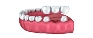 sostituire un solo dente