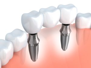 ponte su impianti dentali