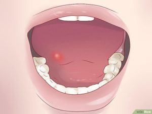 leukoplakia
