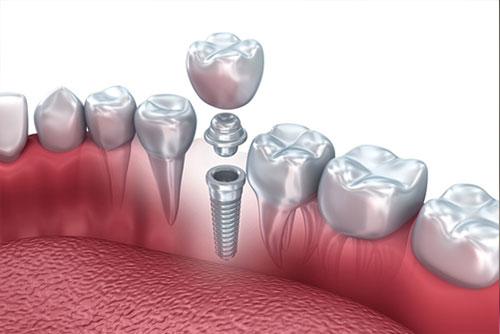 qualità delle protesi dentali