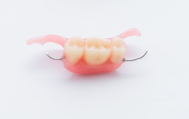 Removable 3-tooth prosthesis