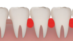 gums that bleed