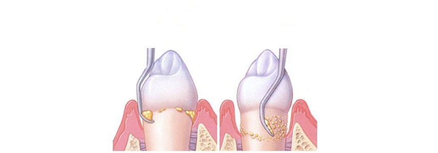 periodontal pocket