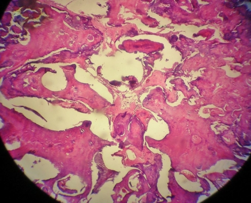 odontoma