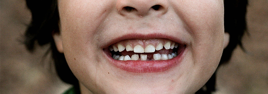 anchilosi del dente