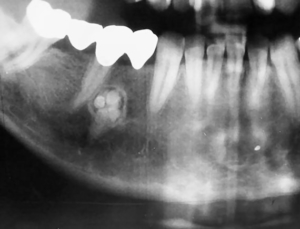 odontoma