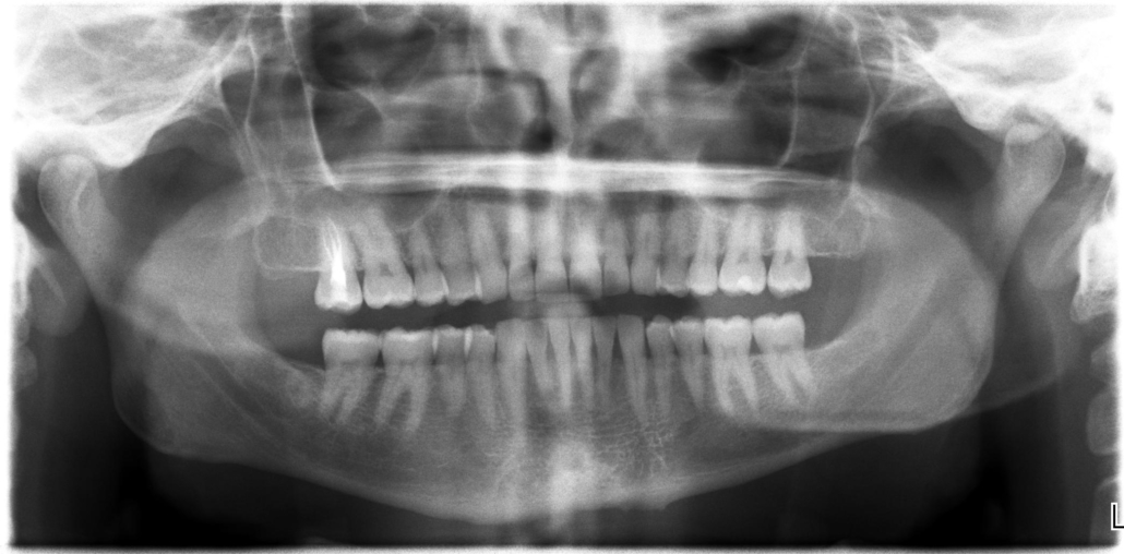 ankylosis of the tooth