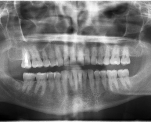ankylosis of the tooth