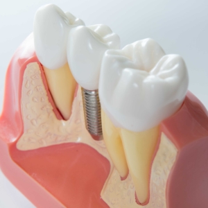 milan dental implants 