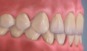 deep bite milan dentist