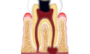 granuloma al dente