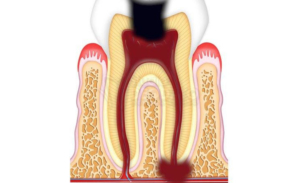 tooth granuloma