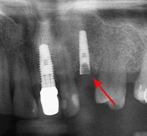 rimozione di un impianto dentale