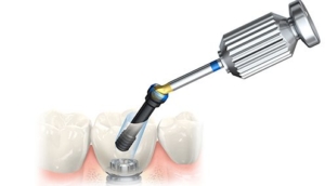 rimozione di un impianto dentale a milano