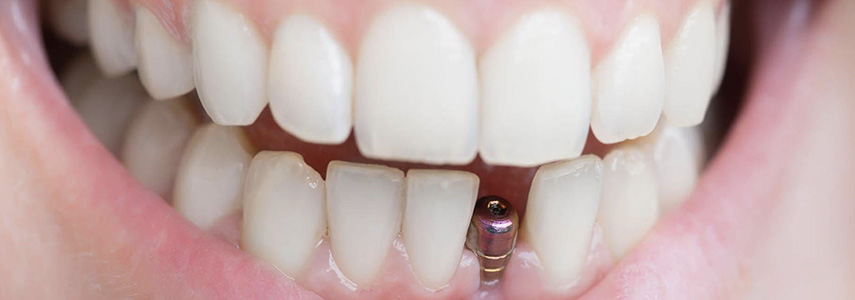 dental implants fracture