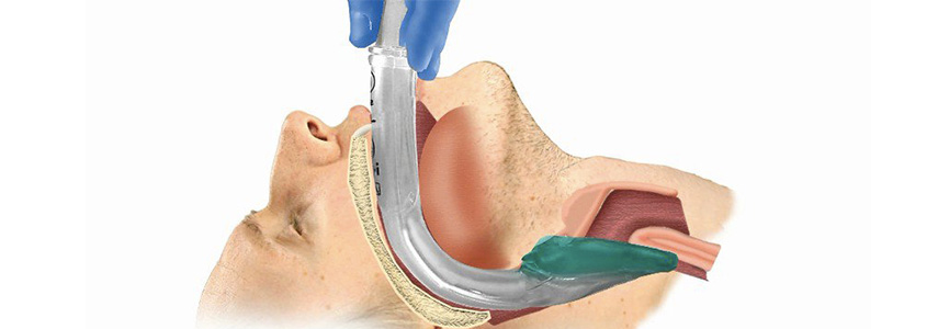 tubo tracheale e danni ai denti