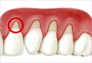 rebuild gingival