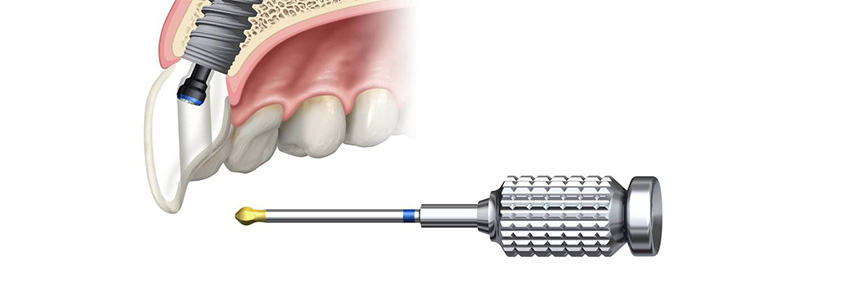removal of a Milan dental implant
