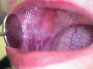oral lachen planus