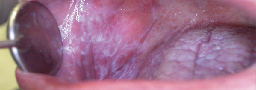 oral lichen planus